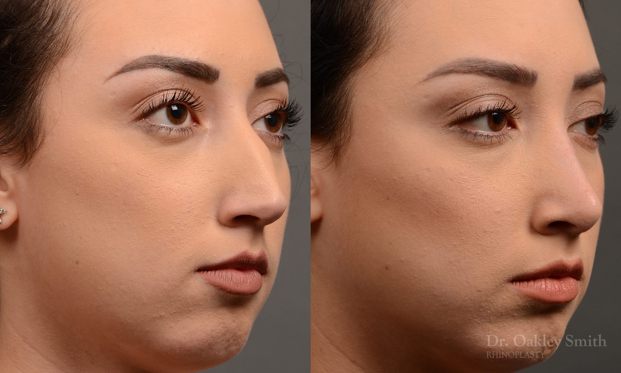 rhinoplasty Nothing demonstrates the skillful craftsmanship that Dr. Oakley Smith accomplishes during his surgeries than a collection of before and after case studies. As one of a hand full of surgeons in North America who limits his practice to only Rhinoplasty surgery, it is obvious that he has mastered his art. There is no question why he is one of the busiest cosmetic nose job surgeons in the country.