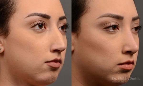 rhinoplasty Nothing demonstrates the skillful craftsmanship that Dr. Oakley Smith accomplishes during his surgeries than a collection of before and after case studies. As one of a hand full of surgeons in North America who limits his practice to only Rhinoplasty surgery, it is obvious that he has mastered his art. There is no question why he is one of the busiest cosmetic nose job surgeons in the country.