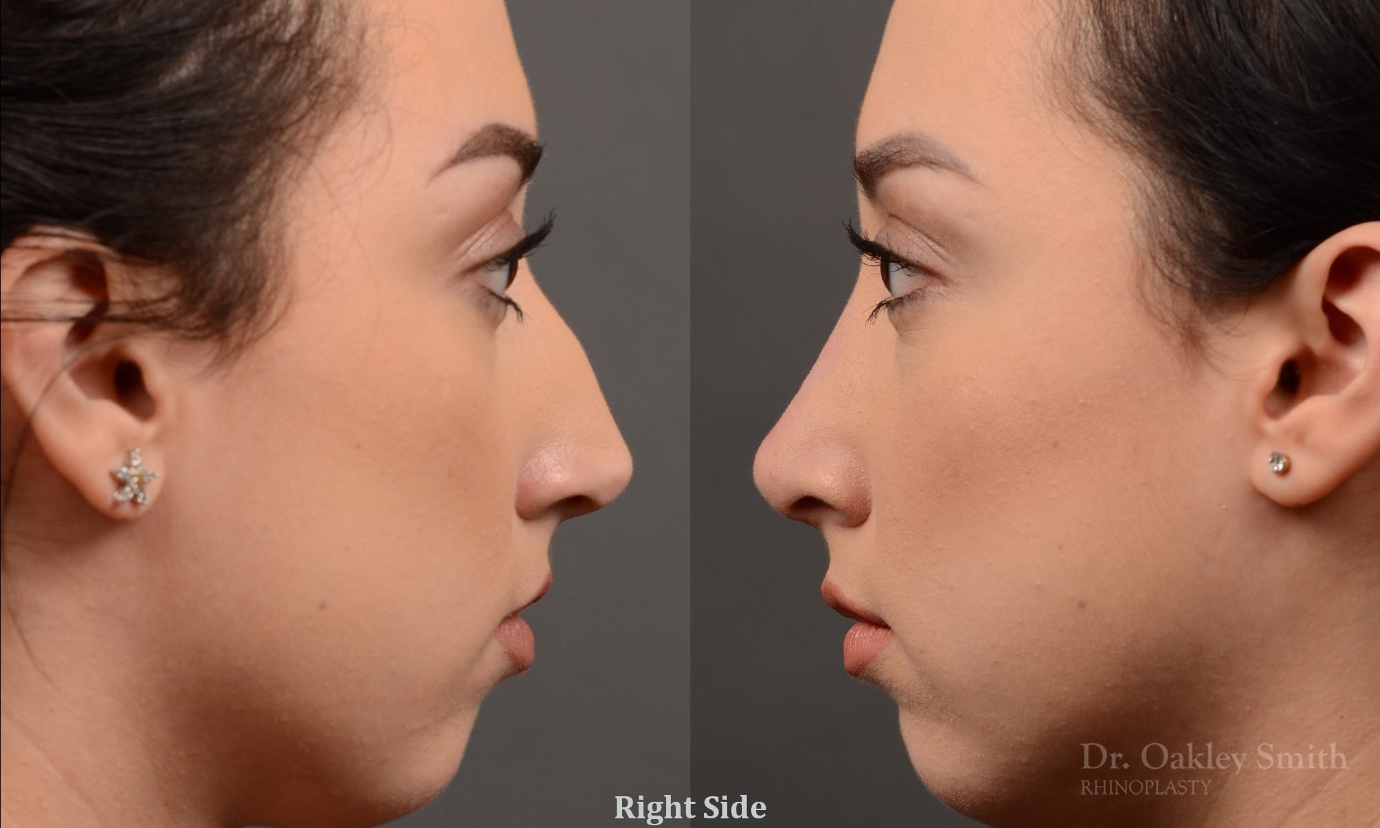 rhinoplasty Nothing demonstrates the skillful craftsmanship that Dr. Oakley Smith accomplishes during his surgeries than a collection of before and after case studies. As one of a hand full of surgeons in North America who limits his practice to only Rhinoplasty surgery, it is obvious that he has mastered his art. There is no question why he is one of the busiest cosmetic nose job surgeons in the country.
