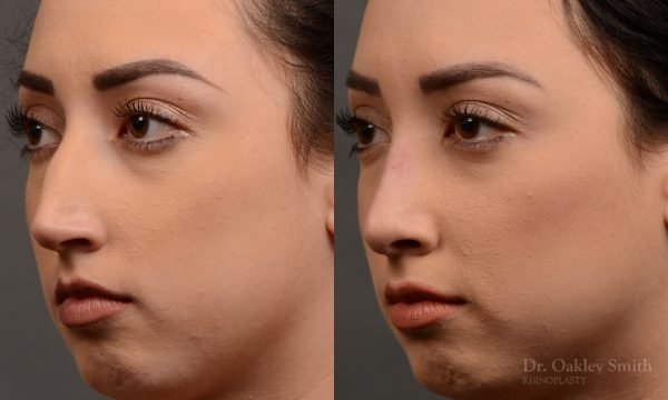 rhinoplasty Nothing demonstrates the skillful craftsmanship that Dr. Oakley Smith accomplishes during his surgeries than a collection of before and after case studies. As one of a hand full of surgeons in North America who limits his practice to only Rhinoplasty surgery, it is obvious that he has mastered his art. There is no question why he is one of the busiest cosmetic nose job surgeons in the country.