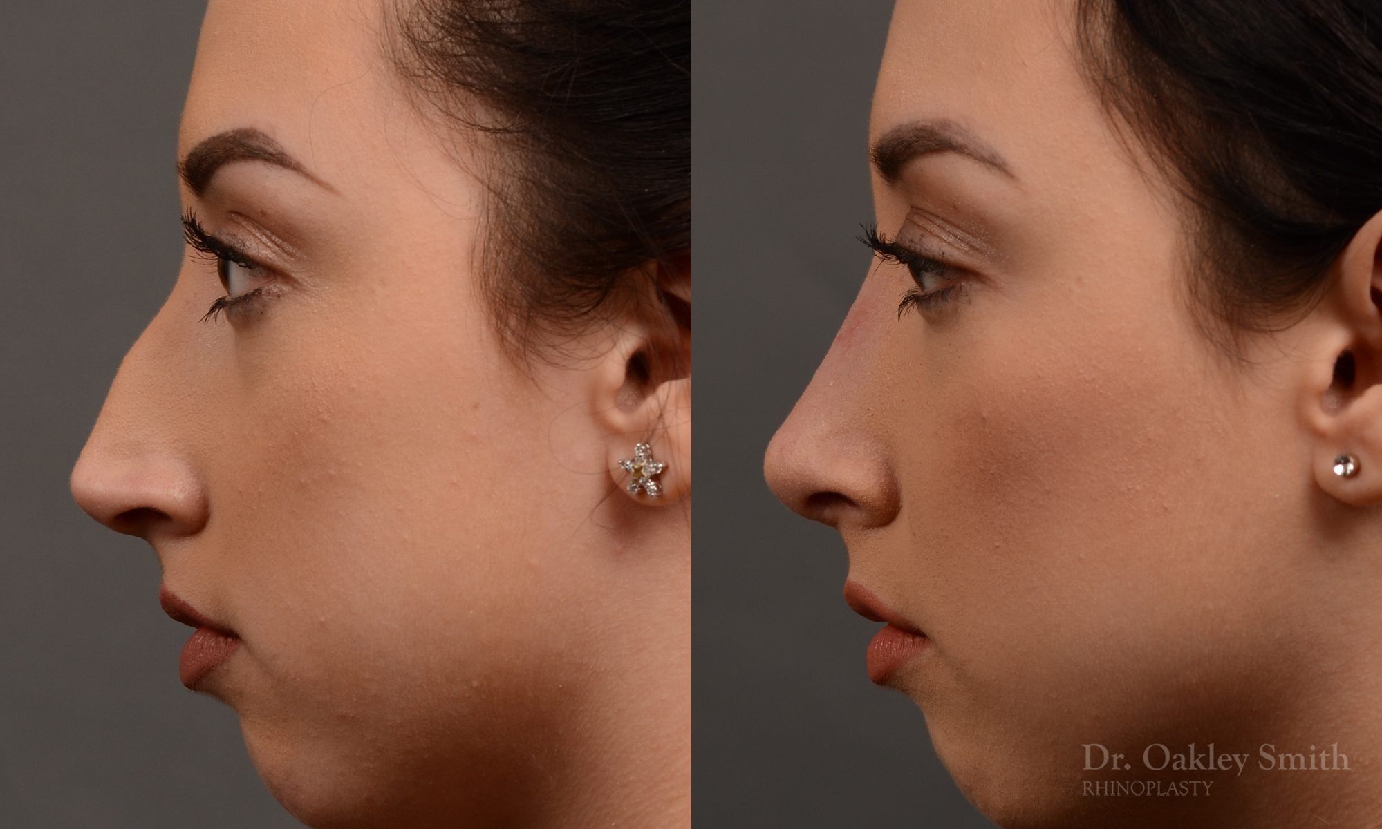 rhinoplasty Nothing demonstrates the skillful craftsmanship that Dr. Oakley Smith accomplishes during his surgeries than a collection of before and after case studies. As one of a hand full of surgeons in North America who limits his practice to only Rhinoplasty surgery, it is obvious that he has mastered his art. There is no question why he is one of the busiest cosmetic nose job surgeons in the country.