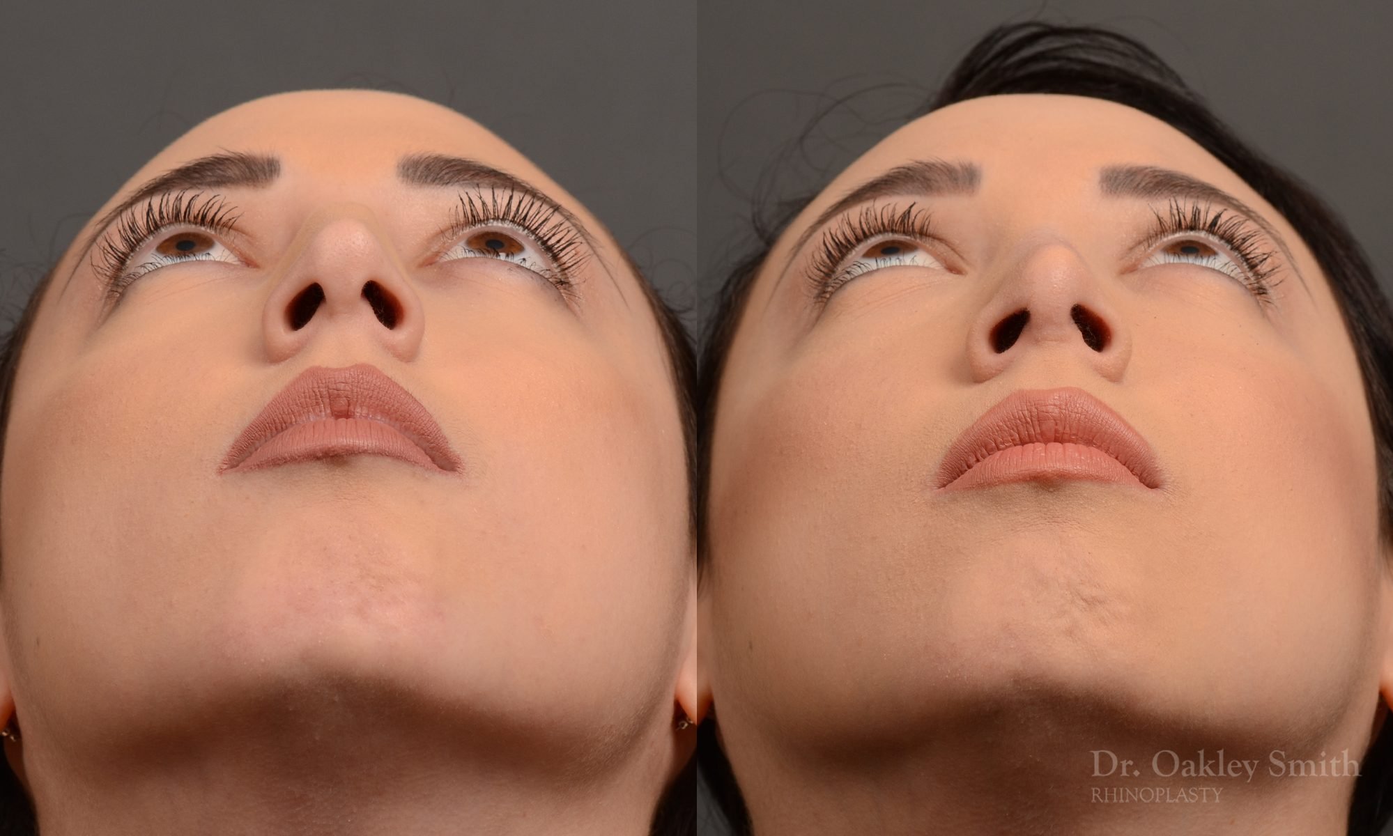 rhinoplasty Nothing demonstrates the skillful craftsmanship that Dr. Oakley Smith accomplishes during his surgeries than a collection of before and after case studies. As one of a hand full of surgeons in North America who limits his practice to only Rhinoplasty surgery, it is obvious that he has mastered his art. There is no question why he is one of the busiest cosmetic nose job surgeons in the country.