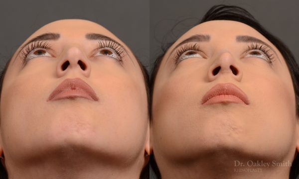 rhinoplasty Nothing demonstrates the skillful craftsmanship that Dr. Oakley Smith accomplishes during his surgeries than a collection of before and after case studies. As one of a hand full of surgeons in North America who limits his practice to only Rhinoplasty surgery, it is obvious that he has mastered his art. There is no question why he is one of the busiest cosmetic nose job surgeons in the country.