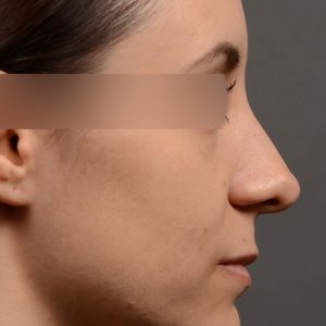 Female rhinoplasty for overall smoother nose