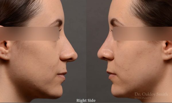 Female rhinoplasty for overall smoother nose