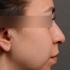 Hump Reduction, Rhinoplasty - Rhinoplasty Before and After Case 342