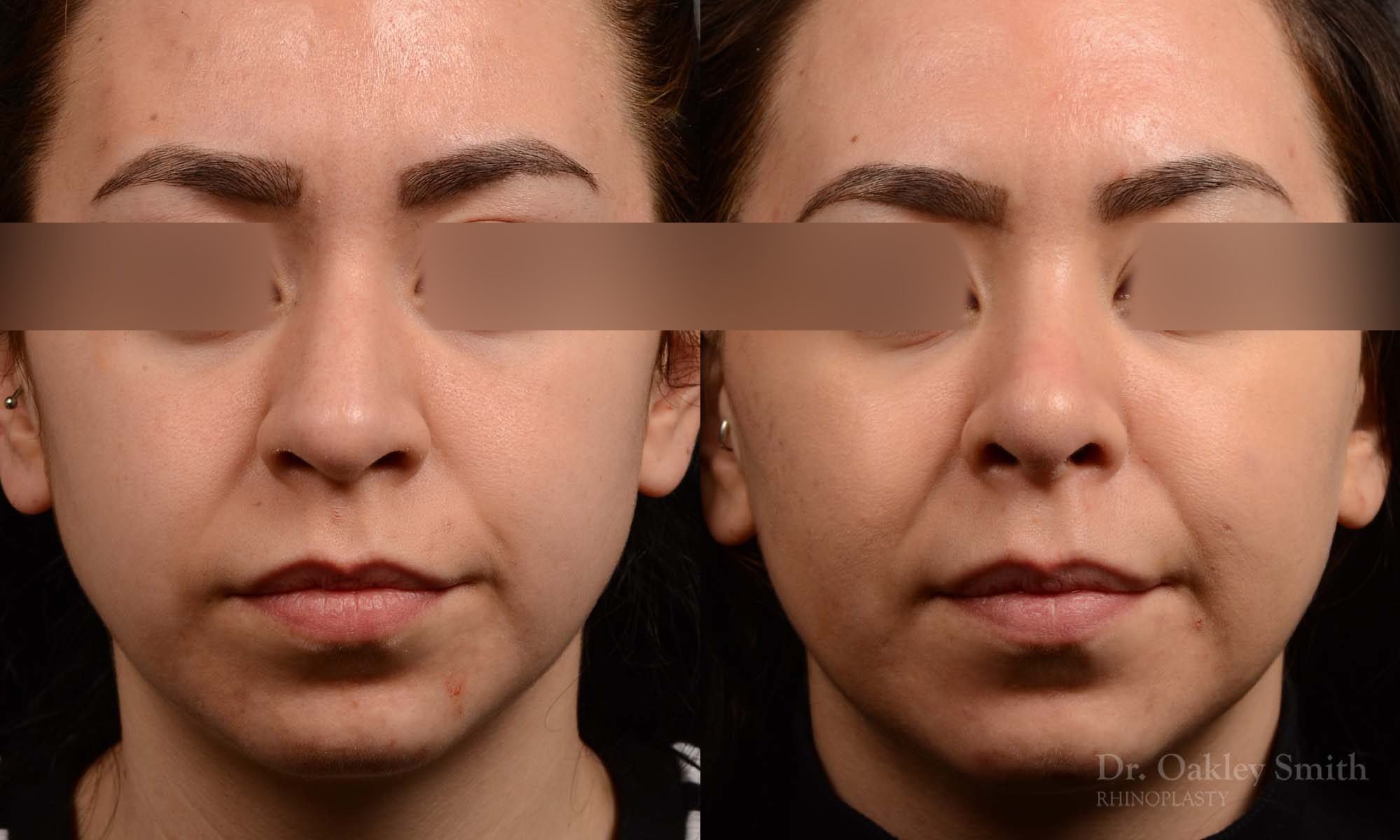 rhinoplasty Nothing demonstrates the skillful craftsmanship that Dr. Oakley Smith accomplishes during his surgeries than a collection of before and after case studies. As one of a hand full of surgeons in North America who limits his practice to only Rhinoplasty surgery, it is obvious that he has mastered his art. There is no question why he is one of the busiest cosmetic nose job surgeons in the country.
