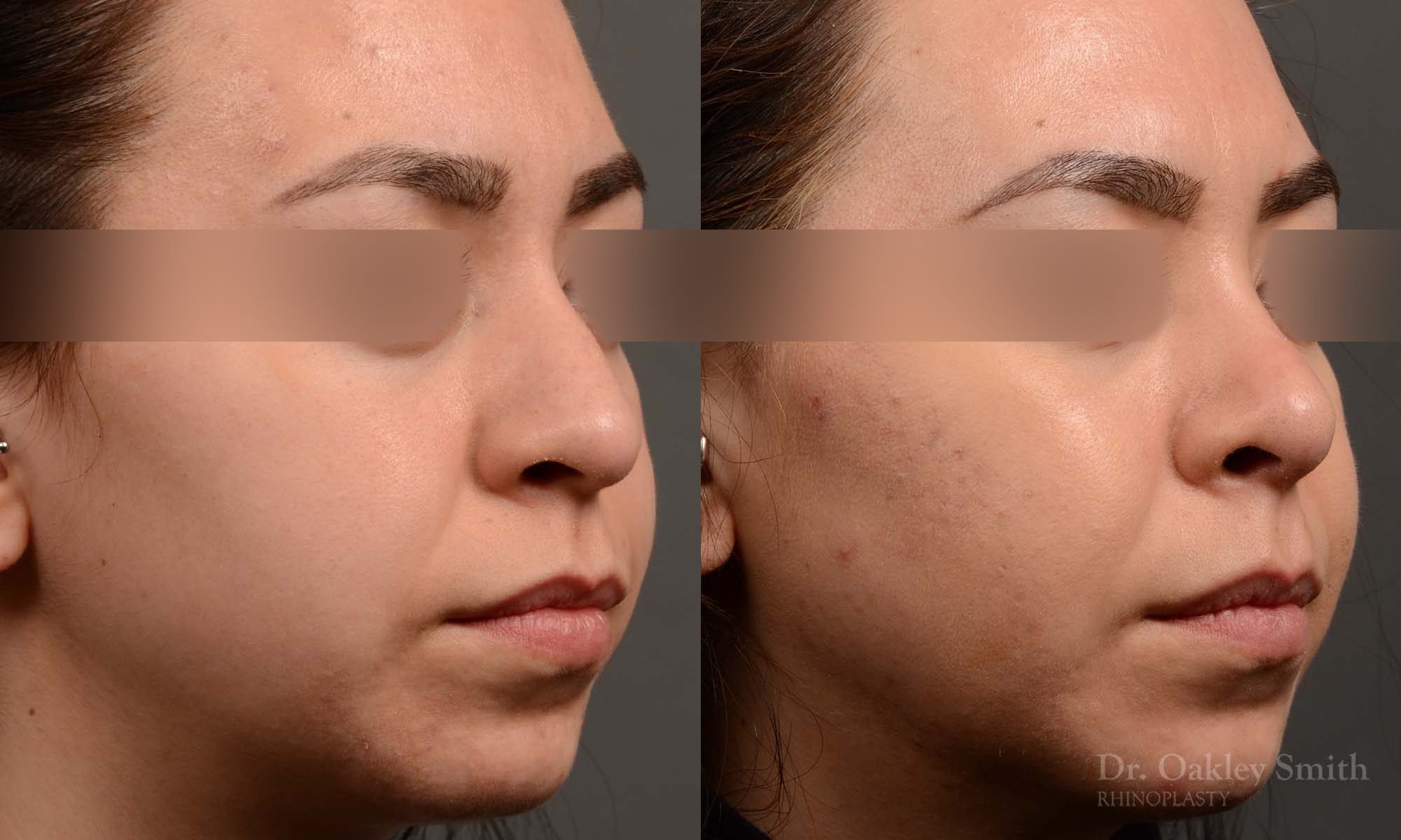 rhinoplasty Nothing demonstrates the skillful craftsmanship that Dr. Oakley Smith accomplishes during his surgeries than a collection of before and after case studies. As one of a hand full of surgeons in North America who limits his practice to only Rhinoplasty surgery, it is obvious that he has mastered his art. There is no question why he is one of the busiest cosmetic nose job surgeons in the country.