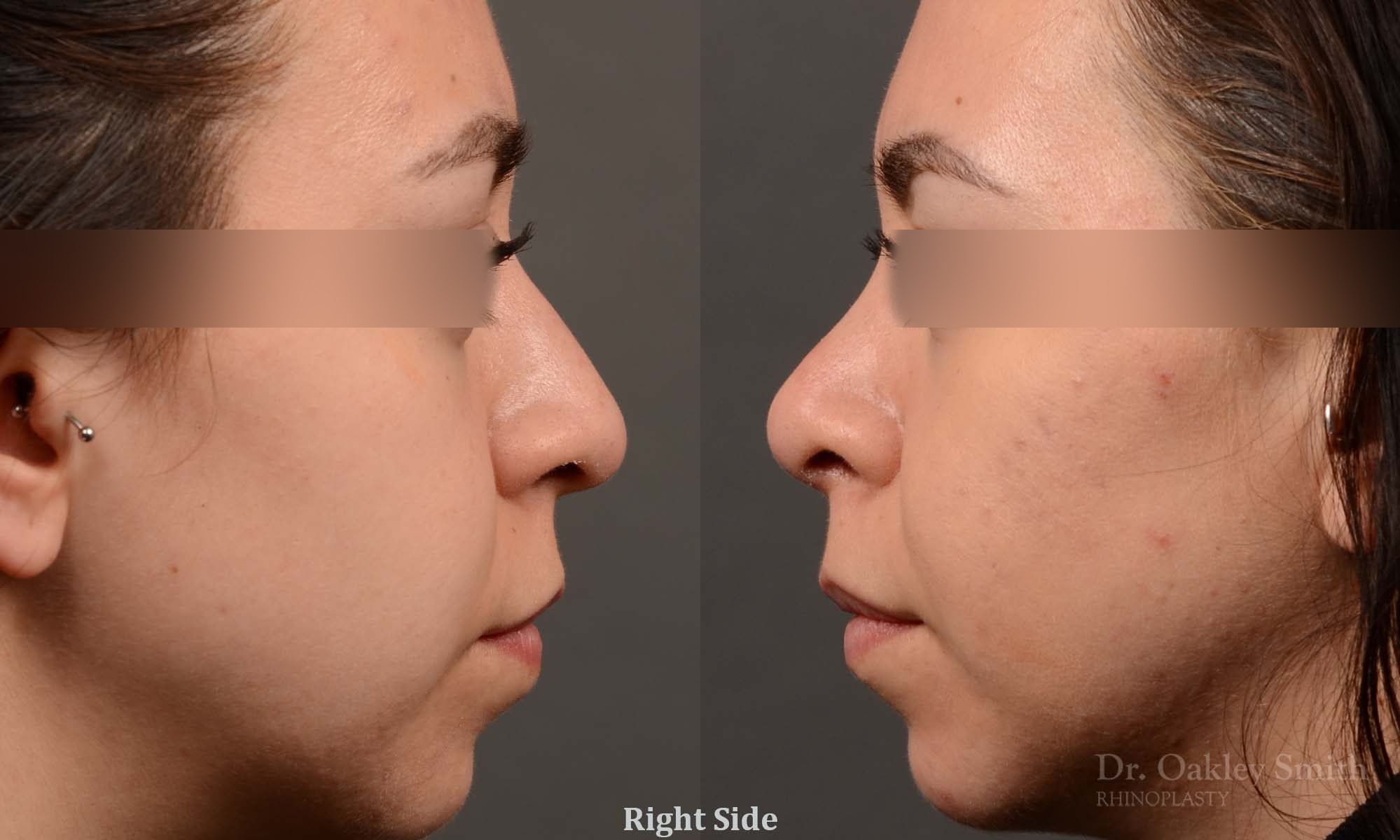 rhinoplasty Nothing demonstrates the skillful craftsmanship that Dr. Oakley Smith accomplishes during his surgeries than a collection of before and after case studies. As one of a hand full of surgeons in North America who limits his practice to only Rhinoplasty surgery, it is obvious that he has mastered his art. There is no question why he is one of the busiest cosmetic nose job surgeons in the country.