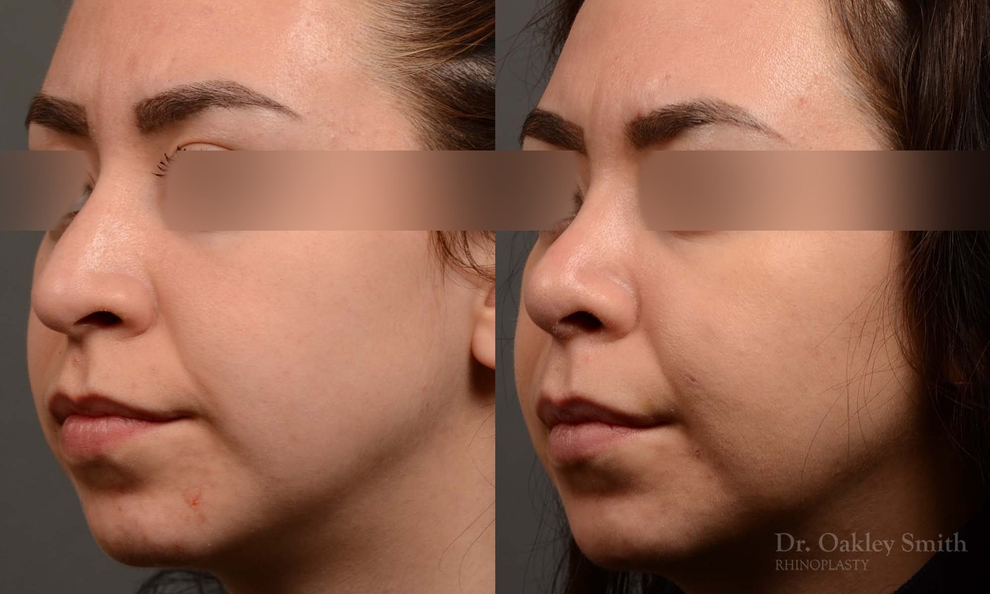 rhinoplasty Nothing demonstrates the skillful craftsmanship that Dr. Oakley Smith accomplishes during his surgeries than a collection of before and after case studies. As one of a hand full of surgeons in North America who limits his practice to only Rhinoplasty surgery, it is obvious that he has mastered his art. There is no question why he is one of the busiest cosmetic nose job surgeons in the country.