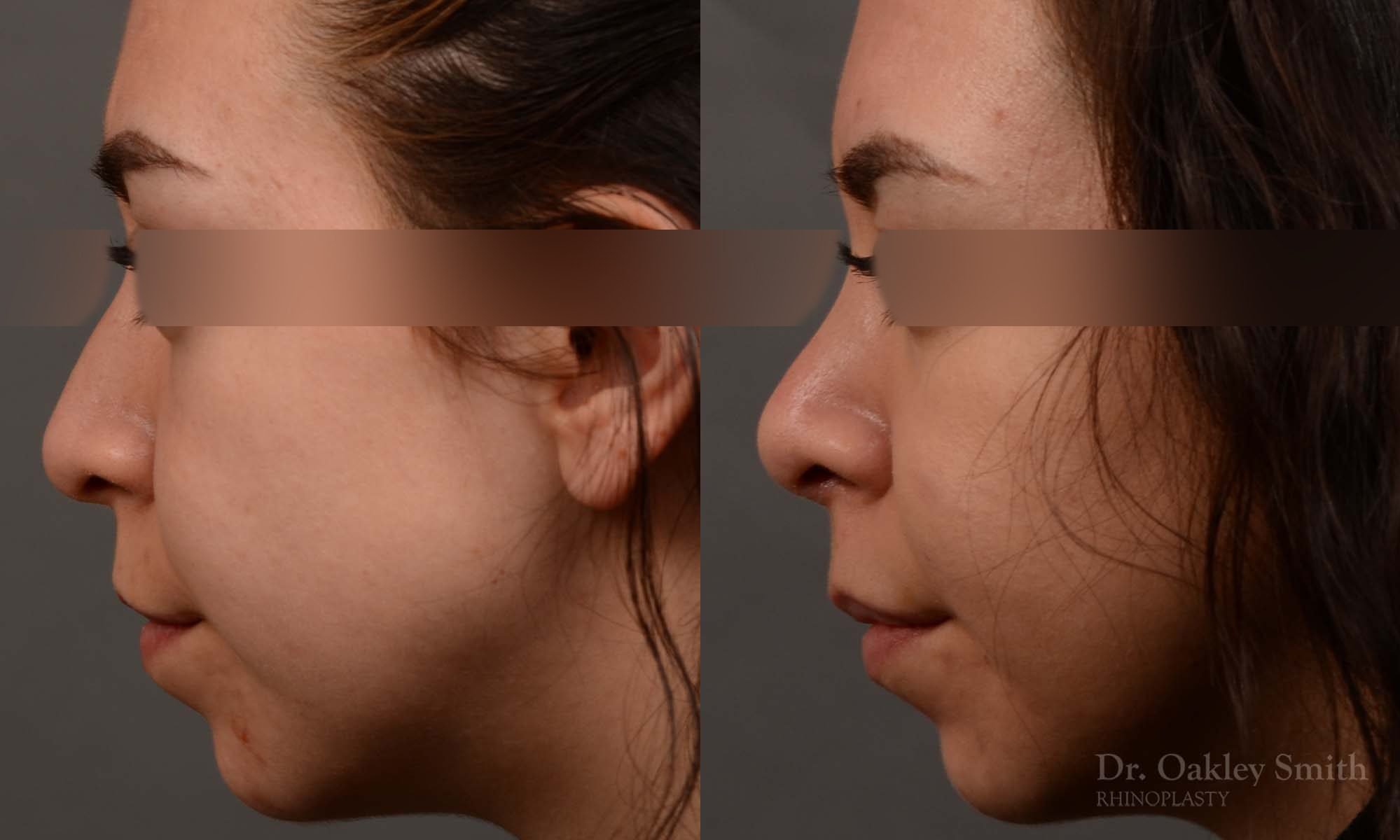 rhinoplasty Nothing demonstrates the skillful craftsmanship that Dr. Oakley Smith accomplishes during his surgeries than a collection of before and after case studies. As one of a hand full of surgeons in North America who limits his practice to only Rhinoplasty surgery, it is obvious that he has mastered his art. There is no question why he is one of the busiest cosmetic nose job surgeons in the country.