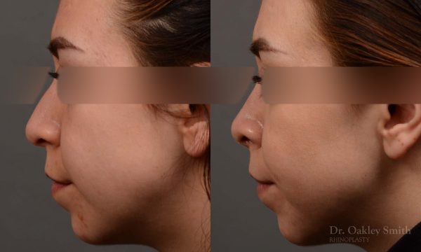 This woman had rhinoplasty to reduce the overall size of her nose. the result is more feminine