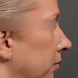 This woman had rhinoplasty to reduce the overall size of her nose. the result is more feminine
