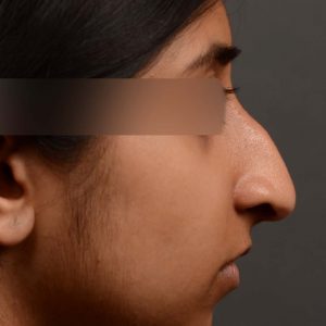 This woman had rhinoplasty to reduce the overall size of her nose. the result is more feminine