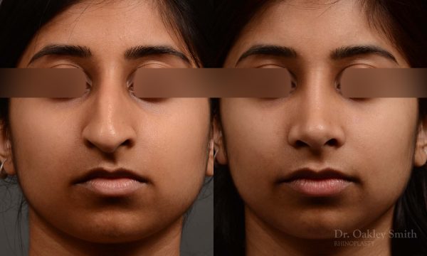rhinoplasty Nothing demonstrates the skillful craftsmanship that Dr. Oakley Smith accomplishes during his surgeries than a collection of before and after case studies. As one of a hand full of surgeons in North America who limits his practice to only Rhinoplasty surgery, it is obvious that he has mastered his art. There is no question why he is one of the busiest cosmetic nose job surgeons in the country.