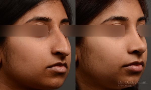 rhinoplasty Nothing demonstrates the skillful craftsmanship that Dr. Oakley Smith accomplishes during his surgeries than a collection of before and after case studies. As one of a hand full of surgeons in North America who limits his practice to only Rhinoplasty surgery, it is obvious that he has mastered his art. There is no question why he is one of the busiest cosmetic nose job surgeons in the country.