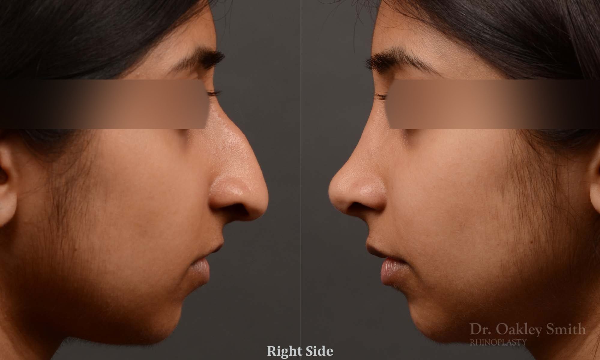 rhinoplasty Nothing demonstrates the skillful craftsmanship that Dr. Oakley Smith accomplishes during his surgeries than a collection of before and after case studies. As one of a hand full of surgeons in North America who limits his practice to only Rhinoplasty surgery, it is obvious that he has mastered his art. There is no question why he is one of the busiest cosmetic nose job surgeons in the country.