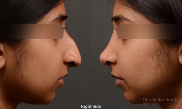 rhinoplasty Nothing demonstrates the skillful craftsmanship that Dr. Oakley Smith accomplishes during his surgeries than a collection of before and after case studies. As one of a hand full of surgeons in North America who limits his practice to only Rhinoplasty surgery, it is obvious that he has mastered his art. There is no question why he is one of the busiest cosmetic nose job surgeons in the country.