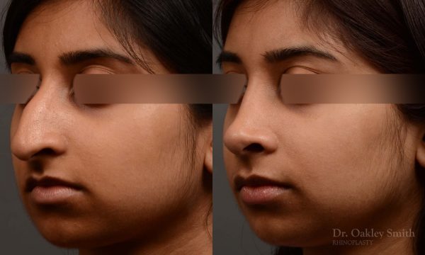 rhinoplasty Nothing demonstrates the skillful craftsmanship that Dr. Oakley Smith accomplishes during his surgeries than a collection of before and after case studies. As one of a hand full of surgeons in North America who limits his practice to only Rhinoplasty surgery, it is obvious that he has mastered his art. There is no question why he is one of the busiest cosmetic nose job surgeons in the country.
