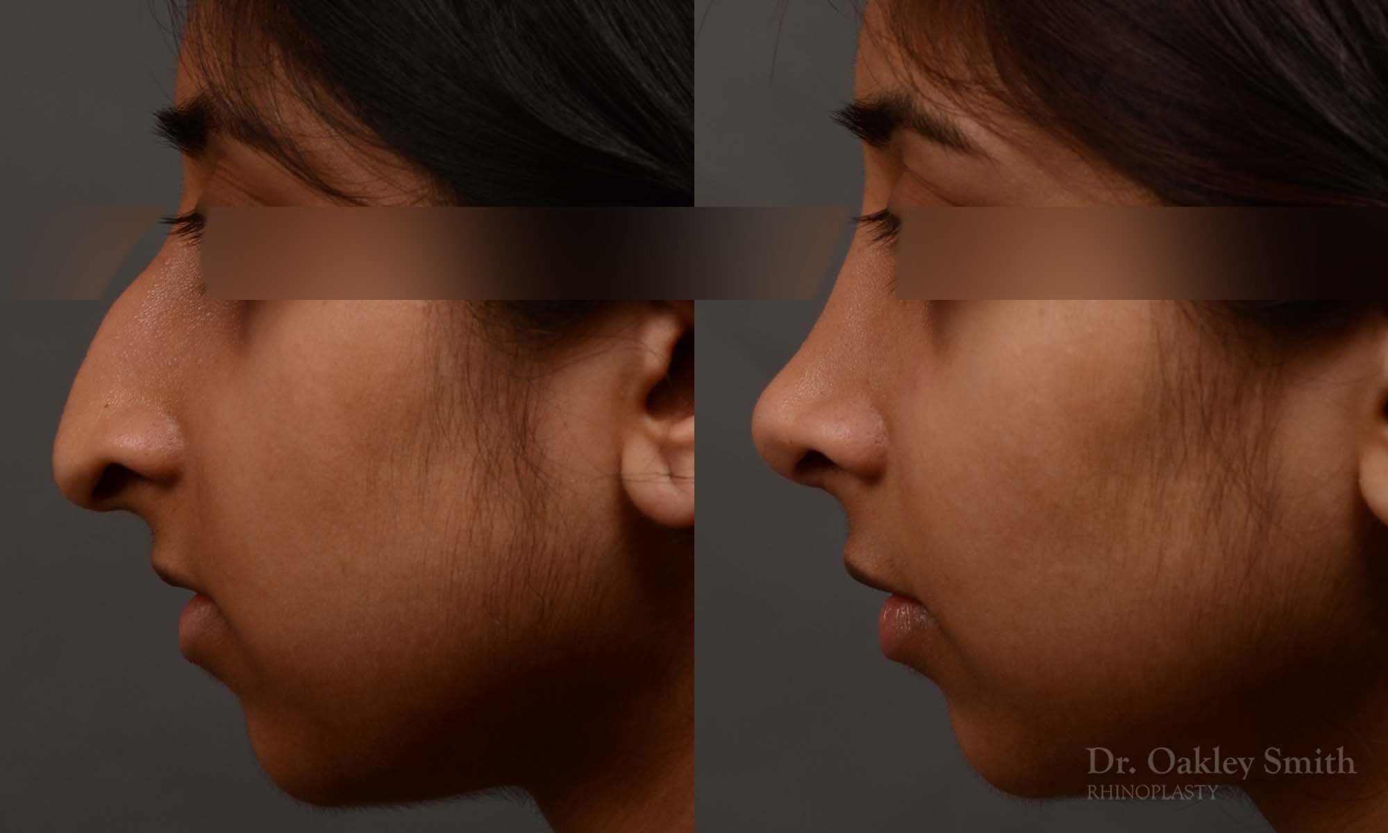 rhinoplasty Nothing demonstrates the skillful craftsmanship that Dr. Oakley Smith accomplishes during his surgeries than a collection of before and after case studies. As one of a hand full of surgeons in North America who limits his practice to only Rhinoplasty surgery, it is obvious that he has mastered his art. There is no question why he is one of the busiest cosmetic nose job surgeons in the country.