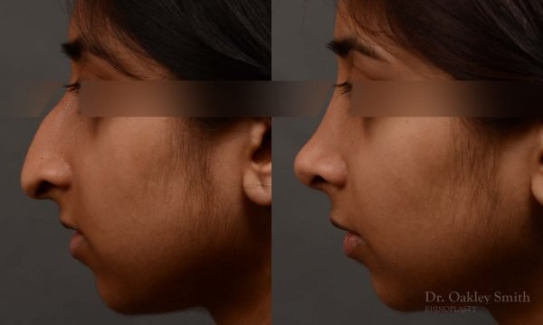 rhinoplasty Nothing demonstrates the skillful craftsmanship that Dr. Oakley Smith accomplishes during his surgeries than a collection of before and after case studies. As one of a hand full of surgeons in North America who limits his practice to only Rhinoplasty surgery, it is obvious that he has mastered his art. There is no question why he is one of the busiest cosmetic nose job surgeons in the country.