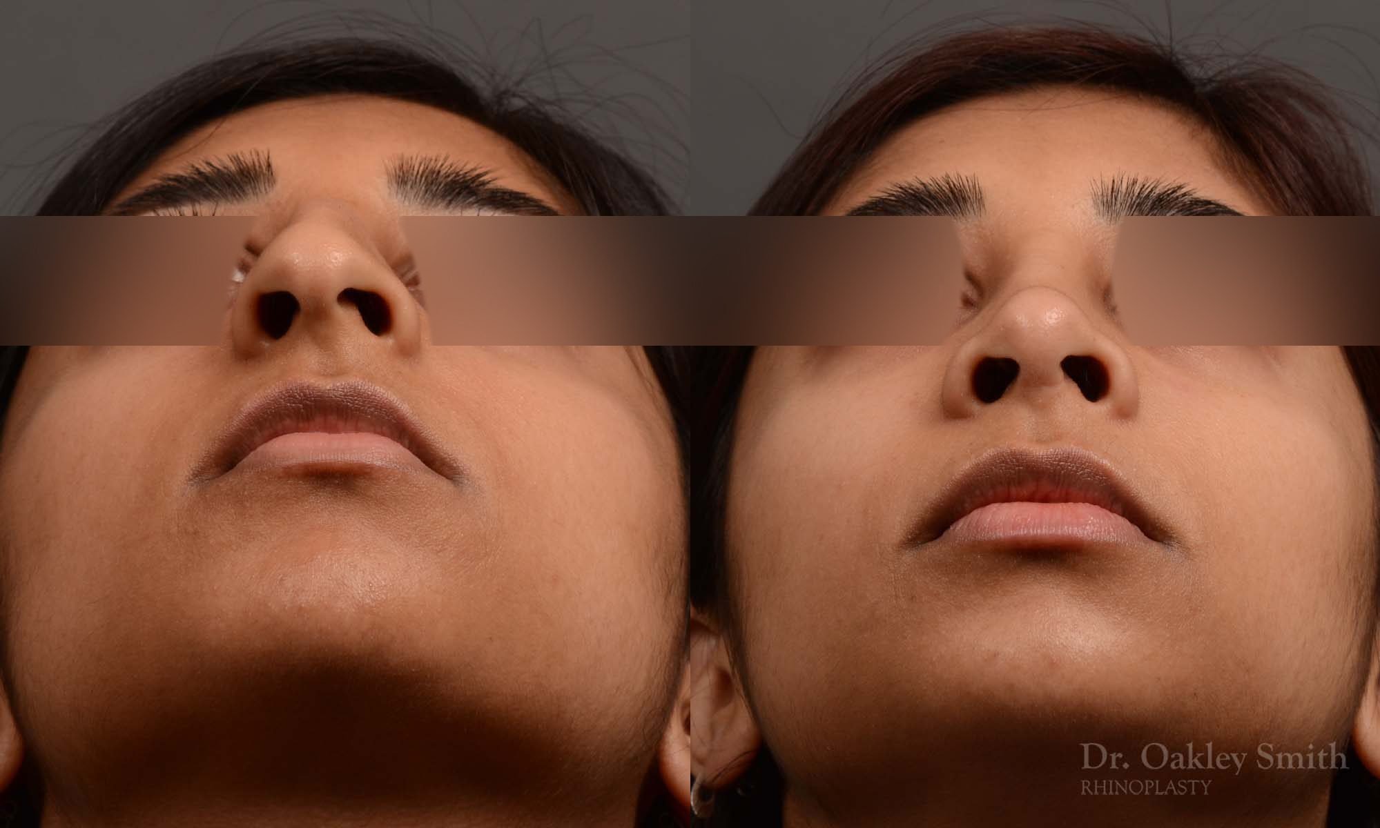 rhinoplasty Nothing demonstrates the skillful craftsmanship that Dr. Oakley Smith accomplishes during his surgeries than a collection of before and after case studies. As one of a hand full of surgeons in North America who limits his practice to only Rhinoplasty surgery, it is obvious that he has mastered his art. There is no question why he is one of the busiest cosmetic nose job surgeons in the country.