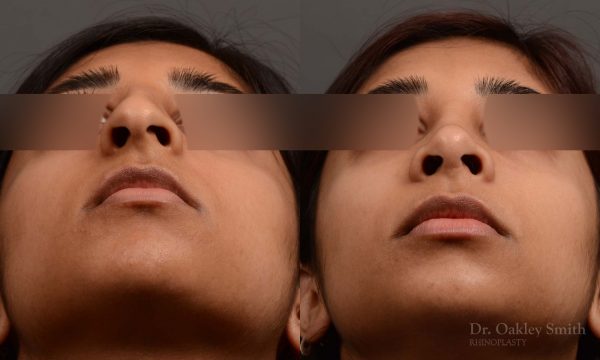 rhinoplasty Nothing demonstrates the skillful craftsmanship that Dr. Oakley Smith accomplishes during his surgeries than a collection of before and after case studies. As one of a hand full of surgeons in North America who limits his practice to only Rhinoplasty surgery, it is obvious that he has mastered his art. There is no question why he is one of the busiest cosmetic nose job surgeons in the country.