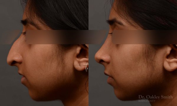 This woman had rhinoplasty to reduce the overall size of her nose. the result is more feminine