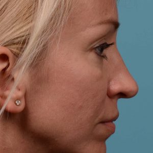 Tip reduction rhinoplasty