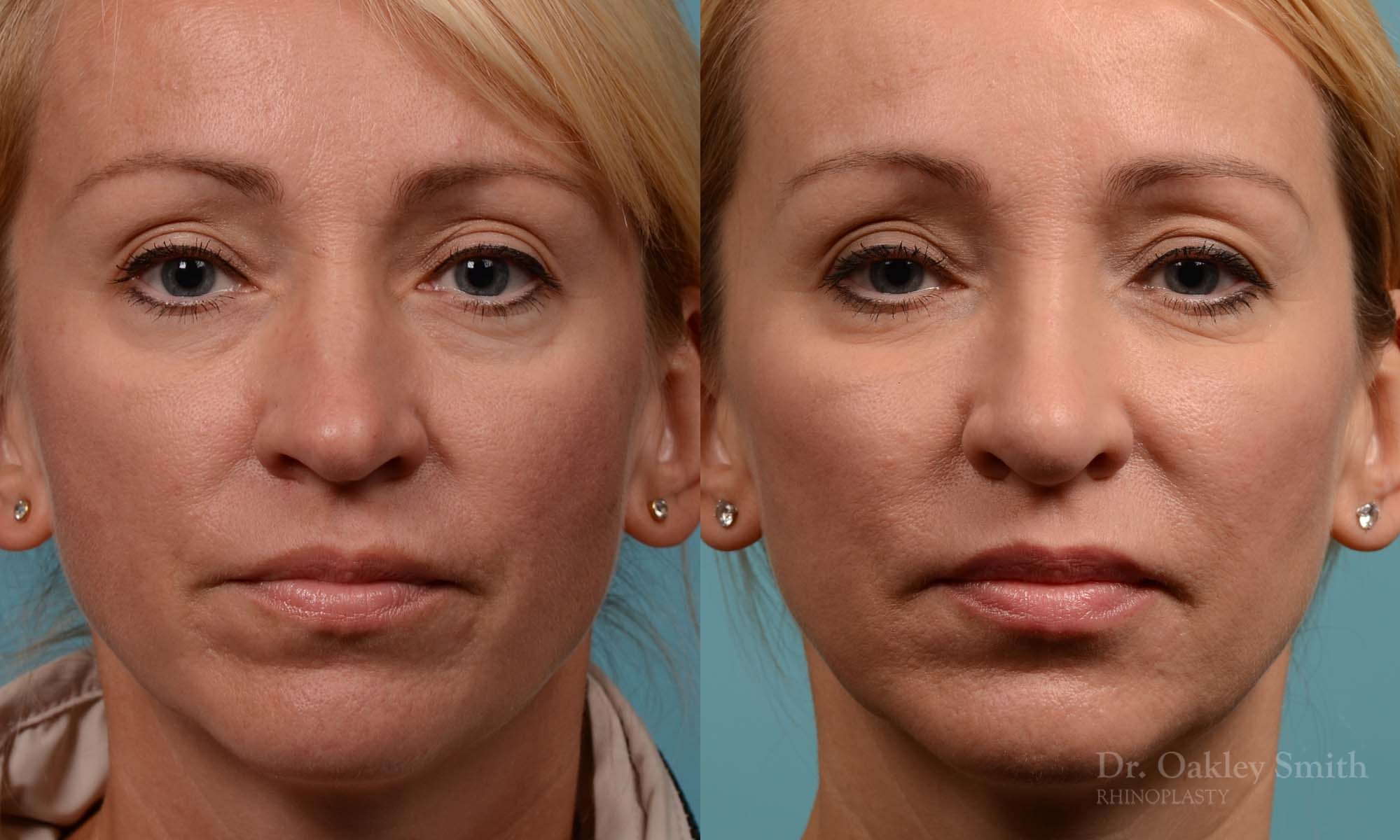 Tip reduction rhinoplasty