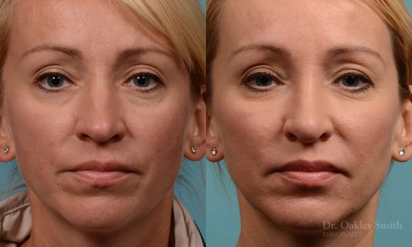Tip reduction rhinoplasty