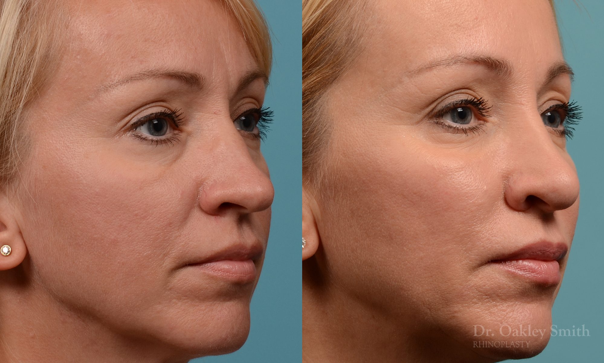 Tip reduction rhinoplasty