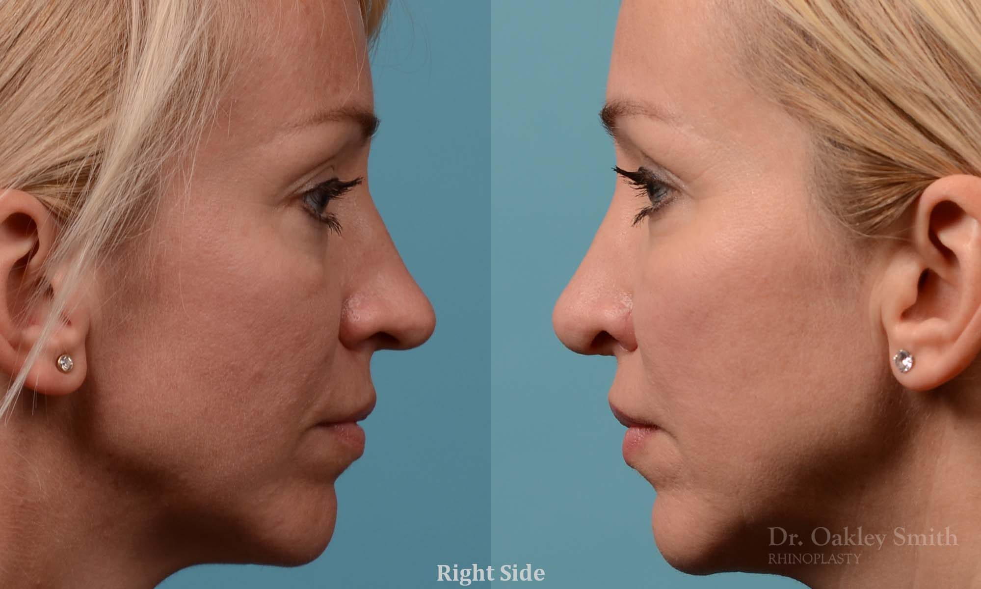 Tip reduction rhinoplasty