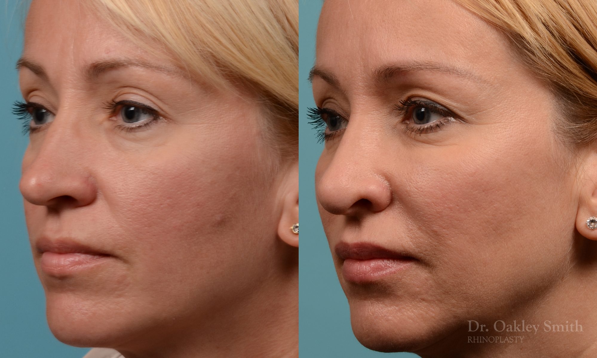 Tip reduction rhinoplasty