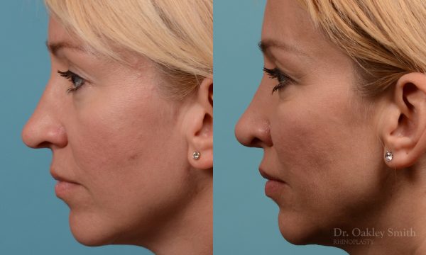Tip reduction rhinoplasty