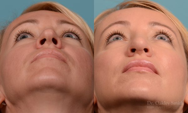 Tip reduction rhinoplasty