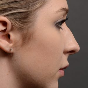 Hump reduction rhinoplasty to create a more feminine nose