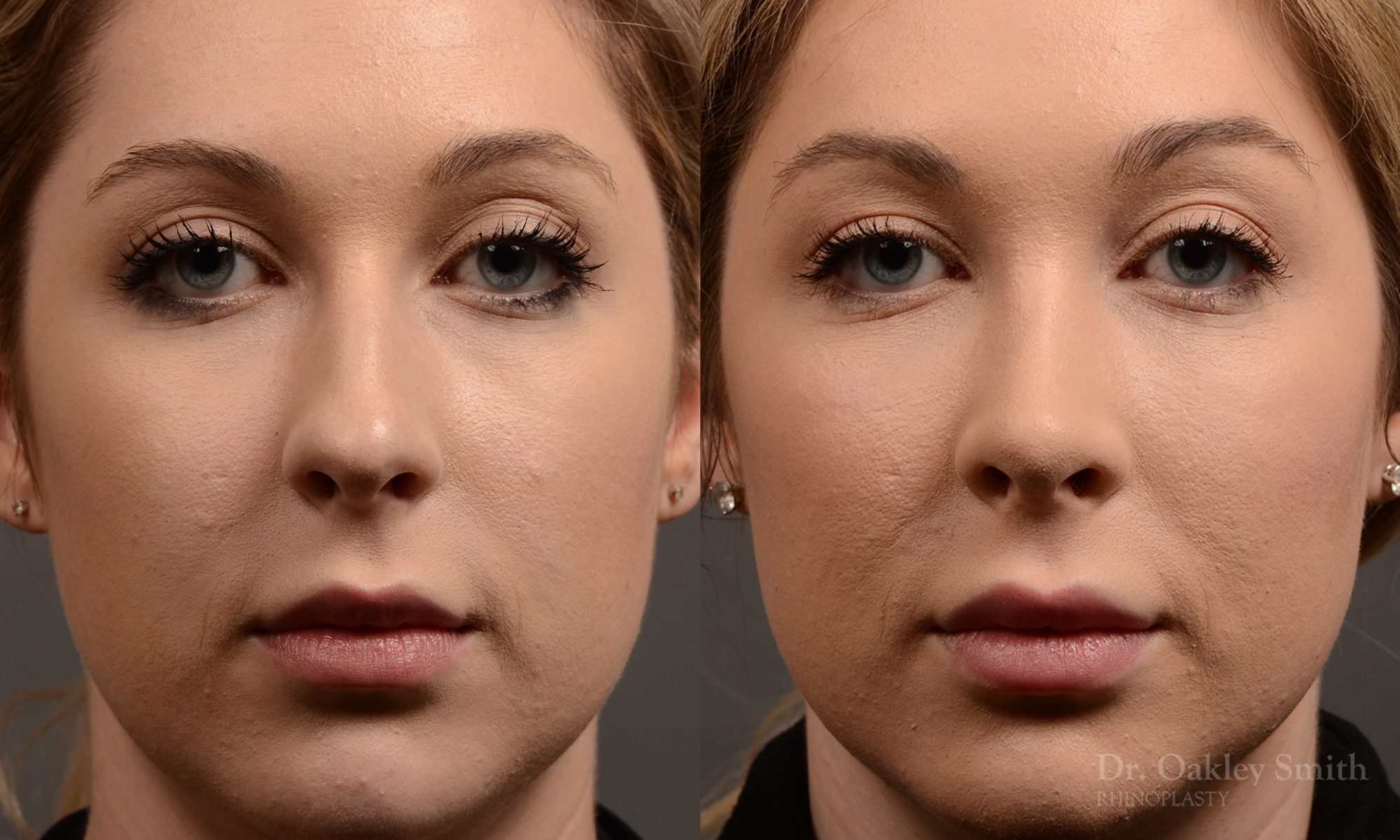 rhinoplasty Nothing demonstrates the skillful craftsmanship that Dr. Oakley Smith accomplishes during his surgeries than a collection of before and after case studies. As one of a hand full of surgeons in North America who limits his practice to only Rhinoplasty surgery, it is obvious that he has mastered his art. There is no question why he is one of the busiest cosmetic nose job surgeons in the country.