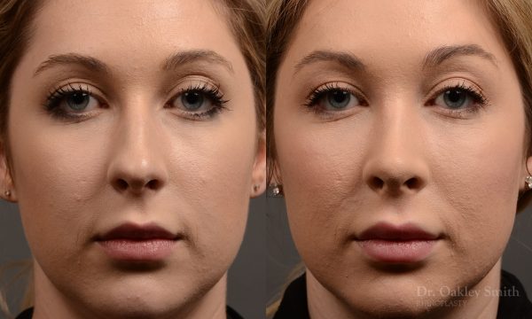 rhinoplasty Nothing demonstrates the skillful craftsmanship that Dr. Oakley Smith accomplishes during his surgeries than a collection of before and after case studies. As one of a hand full of surgeons in North America who limits his practice to only Rhinoplasty surgery, it is obvious that he has mastered his art. There is no question why he is one of the busiest cosmetic nose job surgeons in the country.