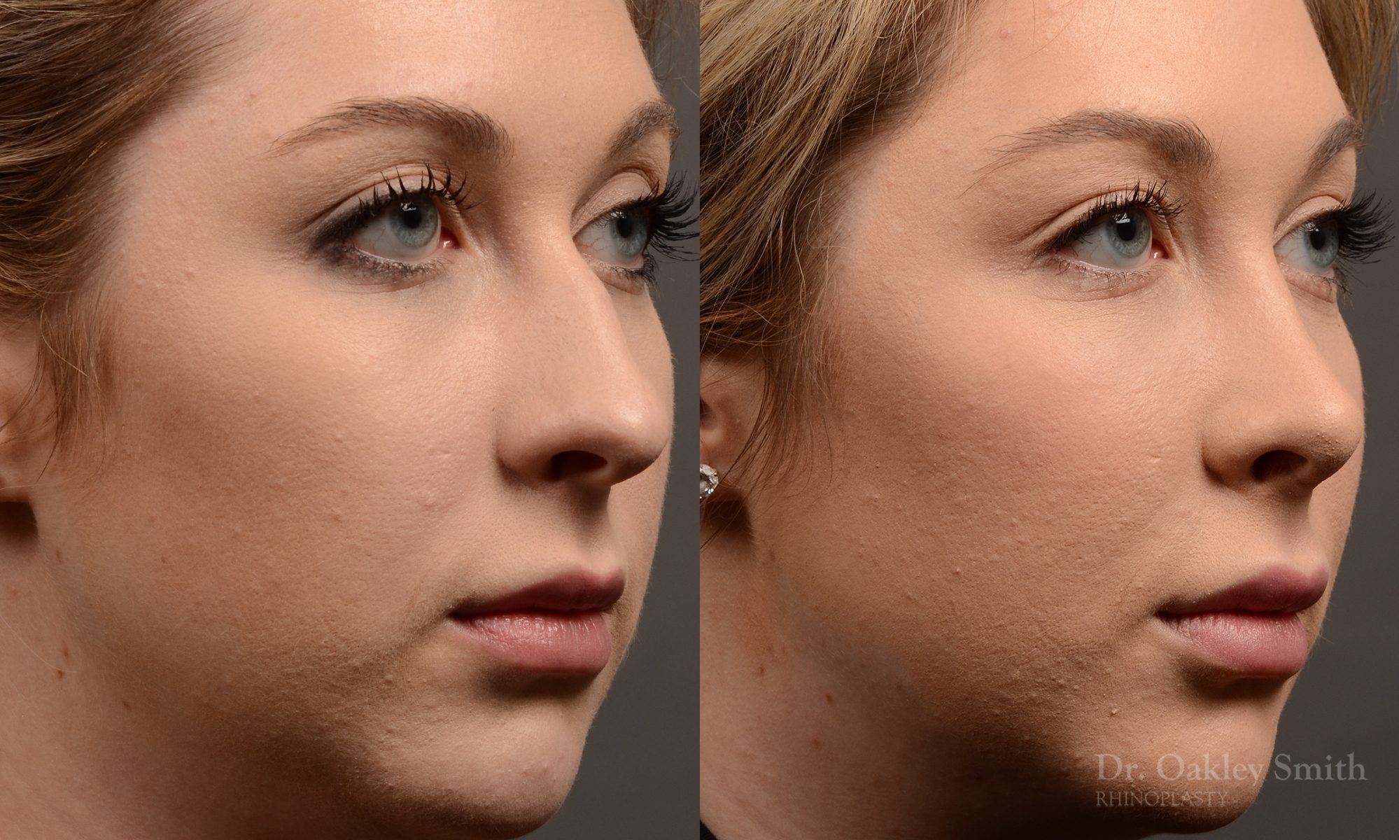 rhinoplasty Nothing demonstrates the skillful craftsmanship that Dr. Oakley Smith accomplishes during his surgeries than a collection of before and after case studies. As one of a hand full of surgeons in North America who limits his practice to only Rhinoplasty surgery, it is obvious that he has mastered his art. There is no question why he is one of the busiest cosmetic nose job surgeons in the country.
