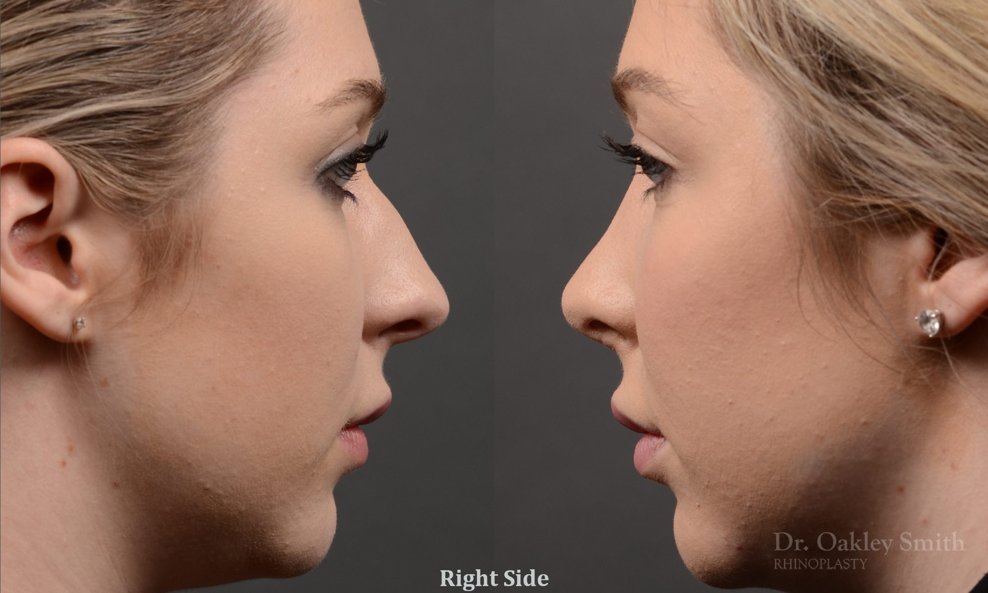 rhinoplasty Nothing demonstrates the skillful craftsmanship that Dr. Oakley Smith accomplishes during his surgeries than a collection of before and after case studies. As one of a hand full of surgeons in North America who limits his practice to only Rhinoplasty surgery, it is obvious that he has mastered his art. There is no question why he is one of the busiest cosmetic nose job surgeons in the country.