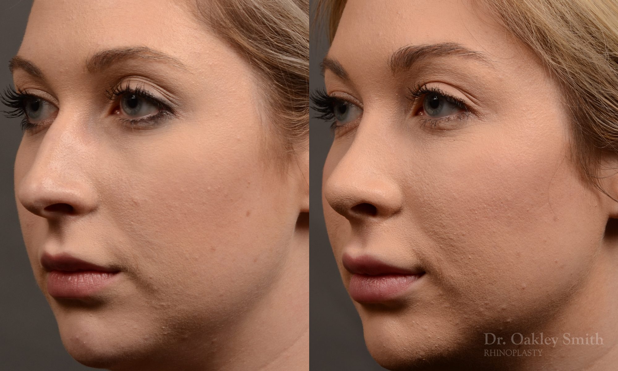 rhinoplasty Nothing demonstrates the skillful craftsmanship that Dr. Oakley Smith accomplishes during his surgeries than a collection of before and after case studies. As one of a hand full of surgeons in North America who limits his practice to only Rhinoplasty surgery, it is obvious that he has mastered his art. There is no question why he is one of the busiest cosmetic nose job surgeons in the country.