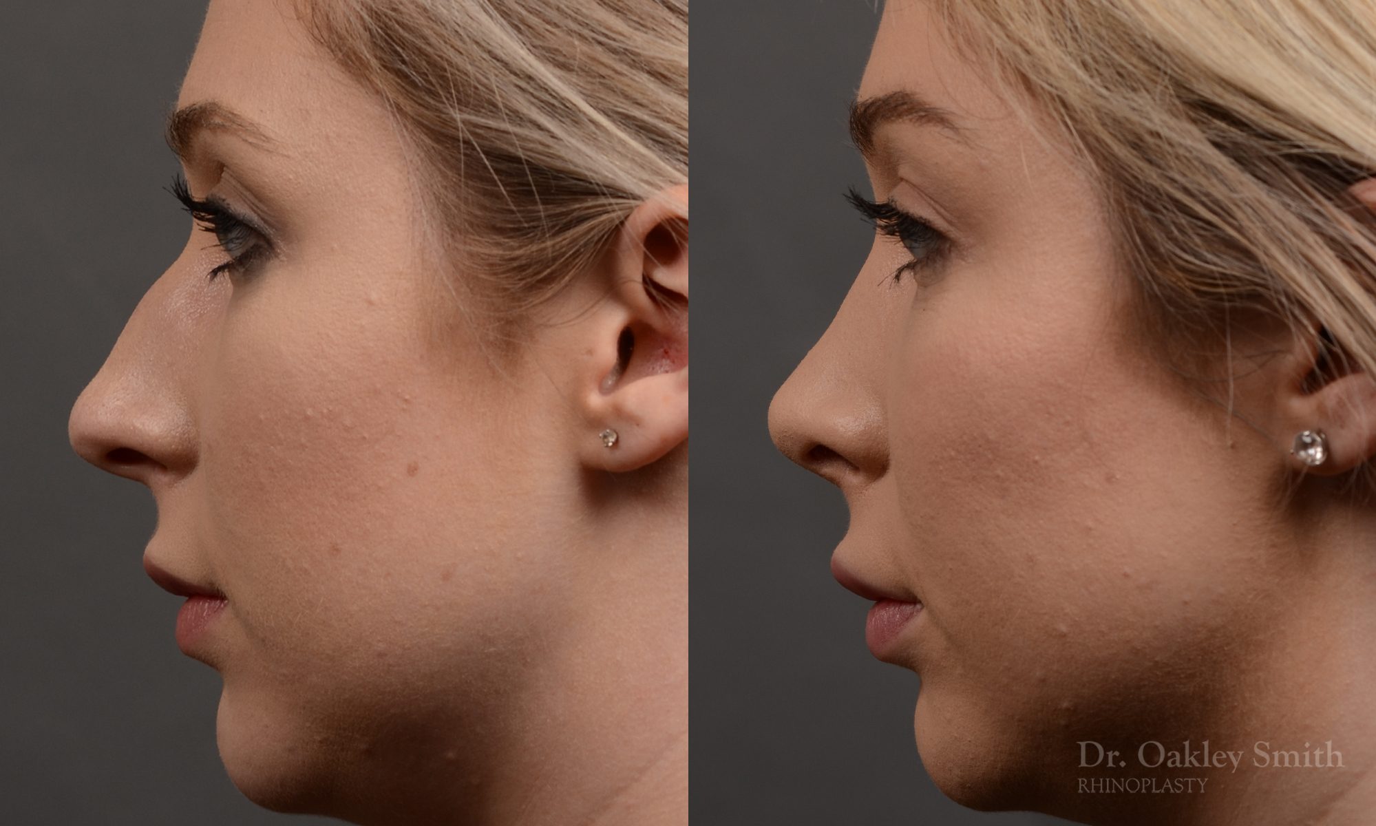 rhinoplasty Nothing demonstrates the skillful craftsmanship that Dr. Oakley Smith accomplishes during his surgeries than a collection of before and after case studies. As one of a hand full of surgeons in North America who limits his practice to only Rhinoplasty surgery, it is obvious that he has mastered his art. There is no question why he is one of the busiest cosmetic nose job surgeons in the country.