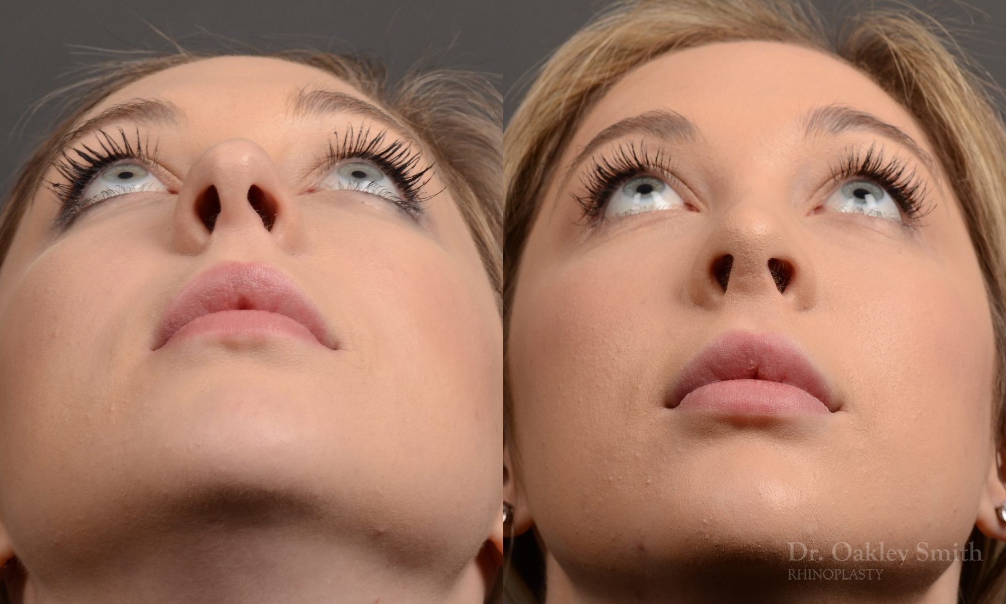 rhinoplasty Nothing demonstrates the skillful craftsmanship that Dr. Oakley Smith accomplishes during his surgeries than a collection of before and after case studies. As one of a hand full of surgeons in North America who limits his practice to only Rhinoplasty surgery, it is obvious that he has mastered his art. There is no question why he is one of the busiest cosmetic nose job surgeons in the country.