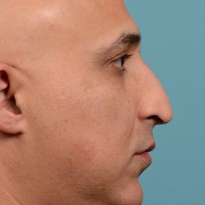 Rhinoplasty nose droop reduction