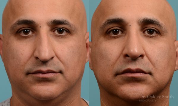 As one of a hand full of surgeons in North America who limits his practice to only Rhinoplasty surgery, it is obvious that he has mastered his art. There is no question why he is one of the busiest cosmetic nose job surgeons in the country.
