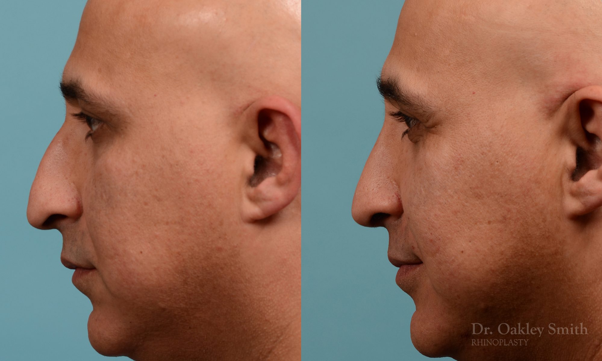 As one of a hand full of surgeons in North America who limits his practice to only Rhinoplasty surgery, it is obvious that he has mastered his art. There is no question why he is one of the busiest cosmetic nose job surgeons in the country.