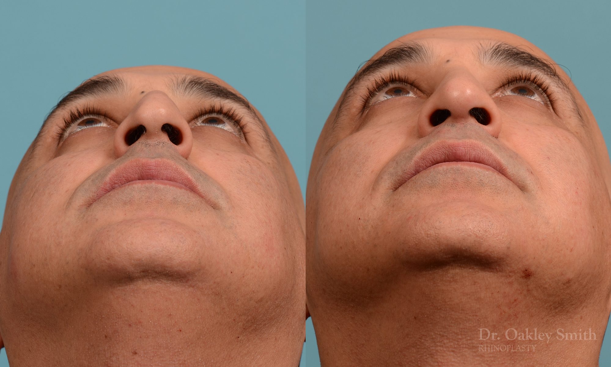 As one of a hand full of surgeons in North America who limits his practice to only Rhinoplasty surgery, it is obvious that he has mastered his art. There is no question why he is one of the busiest cosmetic nose job surgeons in the country.
