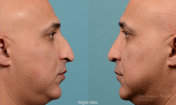 Rhinoplasty nose droop reduction