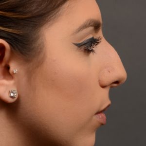 Hump reduction rhinoplasty to create a more feminine nose